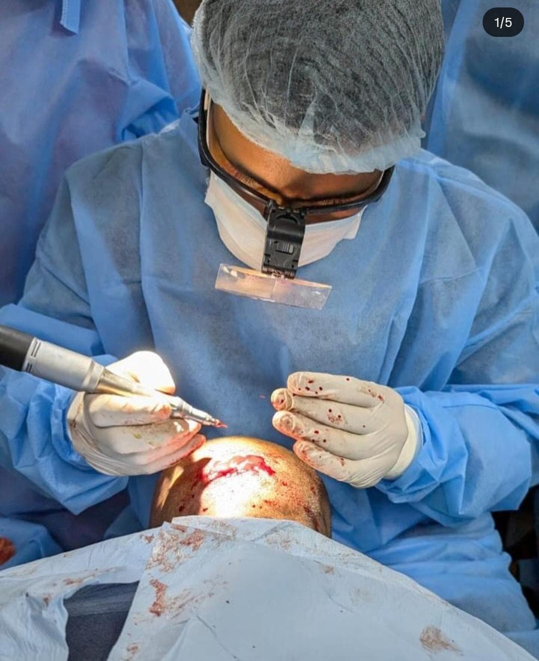 Hair Transplant