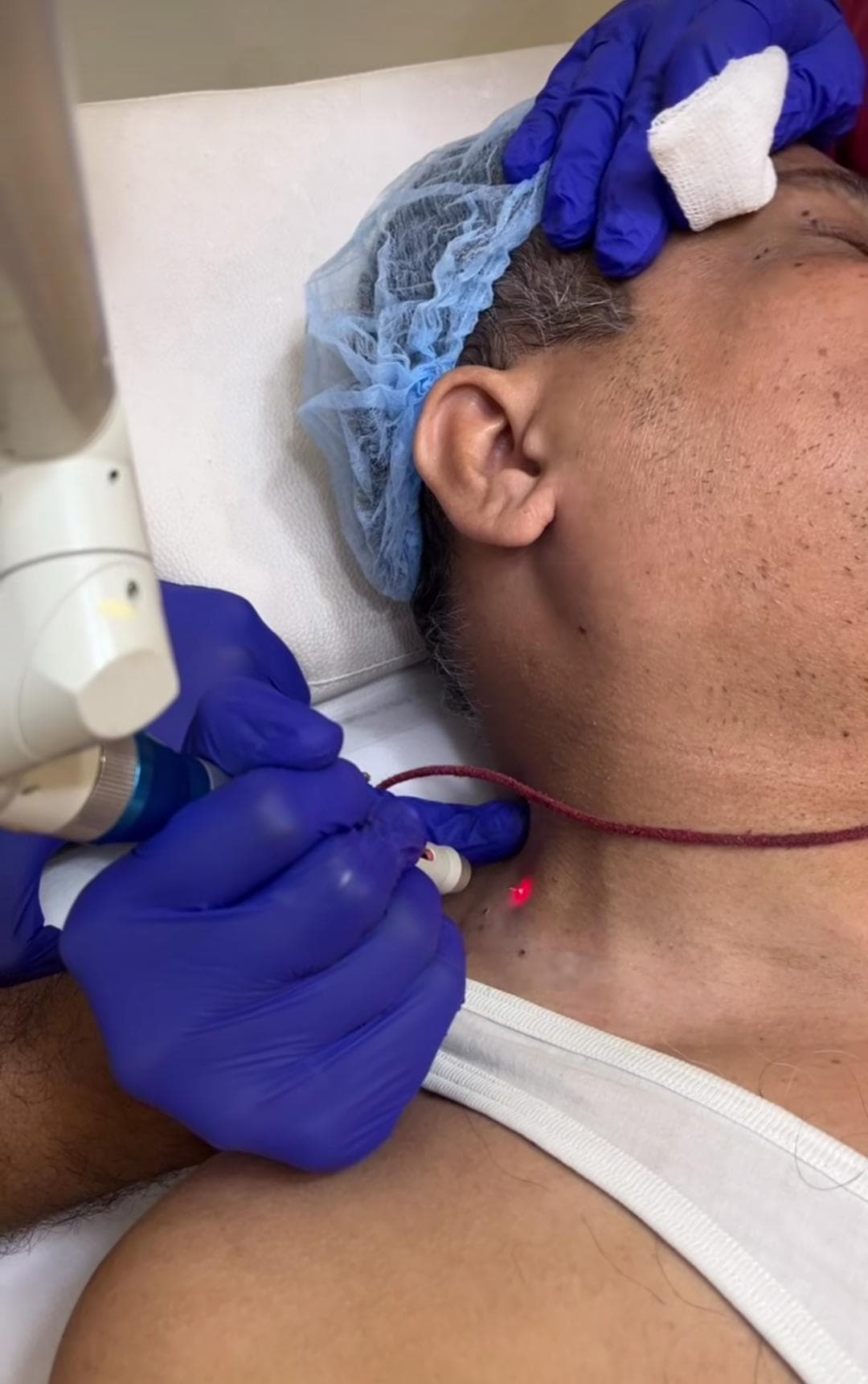 Laser Beam Treatment